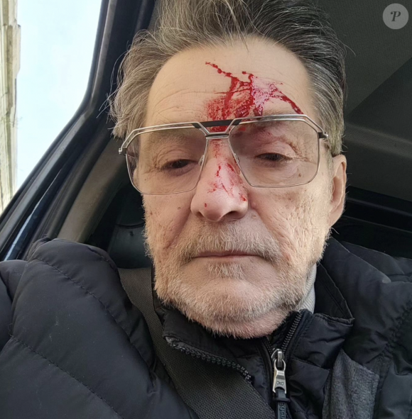 Il y a quelques jours, ce dernier a partagé une photo de lui le visage ensanglanté suite à une agression de rue. 
Michel Bimier, acheteur d'"Affaire conclue", révèle s'être fait agresser sur Instagram