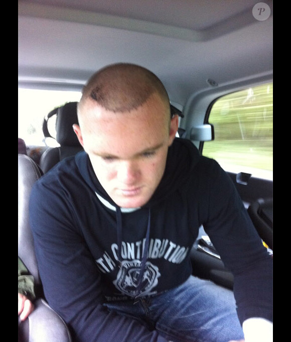 Wayne Rooney le 5 juin 2011. Photo postée sur son Twitter après son implantation capillaire