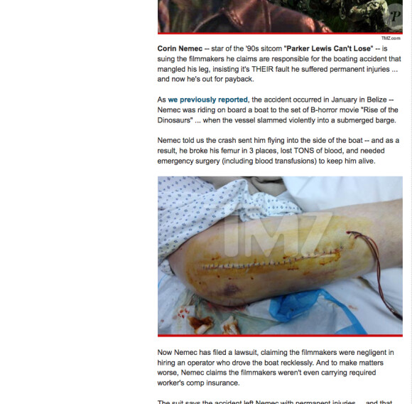 La photo de la jambe blessée de Corin Nemec sur le site TMZ