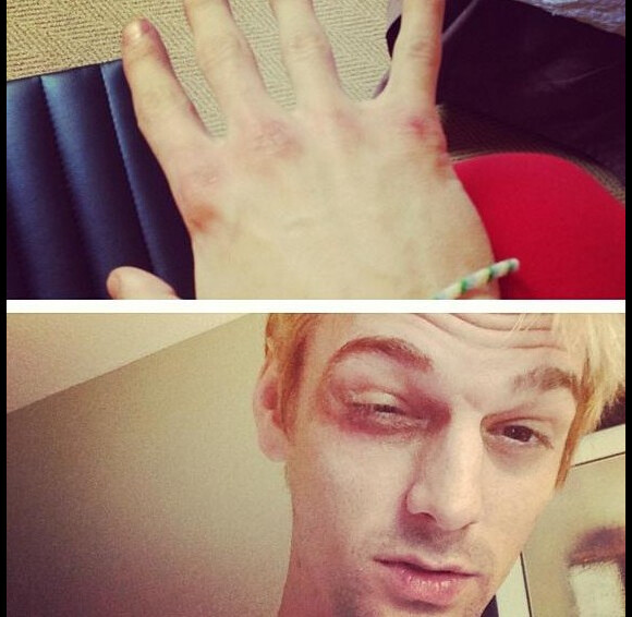 Aaron Carter a posté sur son Instagram des photos de son visage tuméfié après une bagarre à Boston, le 23 juin 2013.