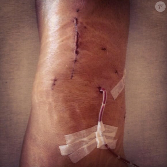 Taïg Kris a été opéré des ligaments croisés du genou droit le 3 septembre dernier.