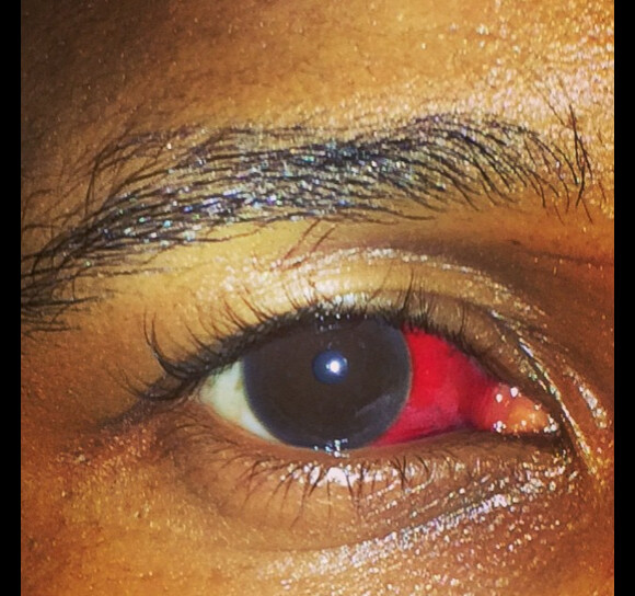 Usher a posté une photo de son oeil blessé après une bagarre qui a lieu pour la soirée du 31 décembre, le chanteur a posté cette photo sur son compte Instagram le 2 janvier 2015.