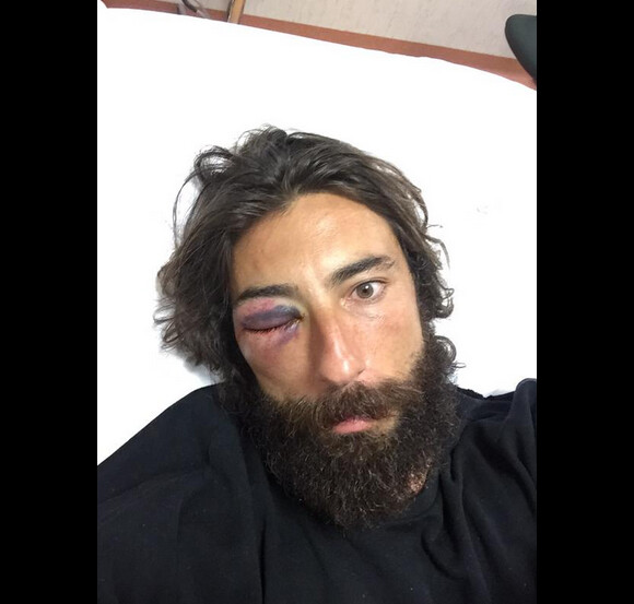 Vittorio Brumotti blessé à l'oeil après une bagarre - août 2015