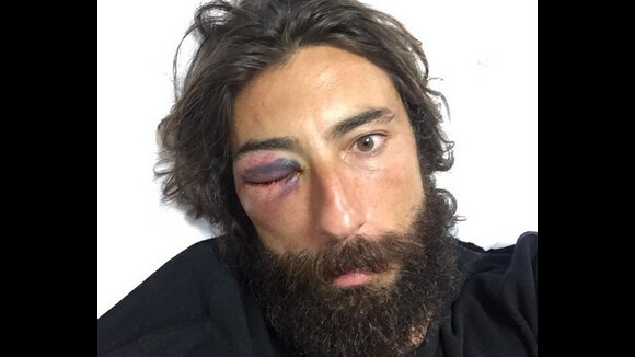 Vittorio Brumotti agressé : Le cycliste de l'extrême pourrait perdre un oeil...