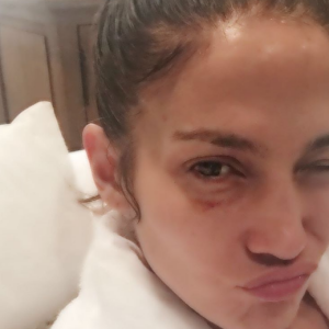 Jennifer Lopez s'est blessée au visage sur le tournage de sa série Shades of Blue. Photo publiée sur Instagram le 1er décembre 2016