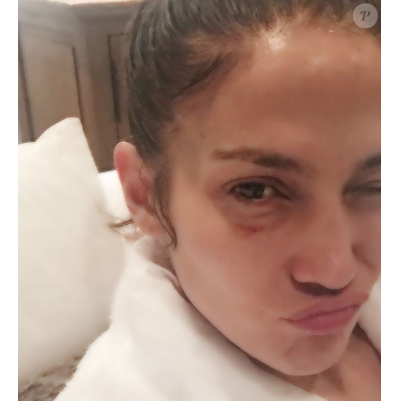 Jennifer Lopez s'est blessée au visage sur le tournage de sa série Shades of Blue. Photo publiée sur Instagram le 1er décembre 2016