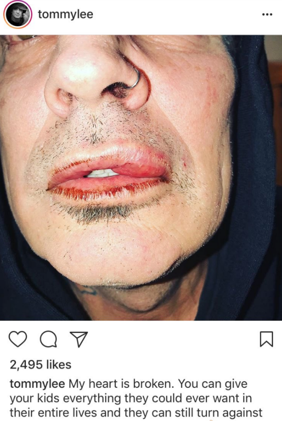Dans une publication postée sur Instagram le 6 mars 2018, l'ex-époux de Pamela Anderson, Tommy Lee, affirme avoir été frappé au visage par leur fils aîné Brandon Thomas (21 ans). Le musicien a par la suite supprimé son message. De son côté, le mannequin assure avoir agi en "légitime défense" face à son père ivre.