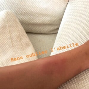 Camille Cerf a été attaquée par des moustiques et des abeilles lors de ses vacances. Août 2018.