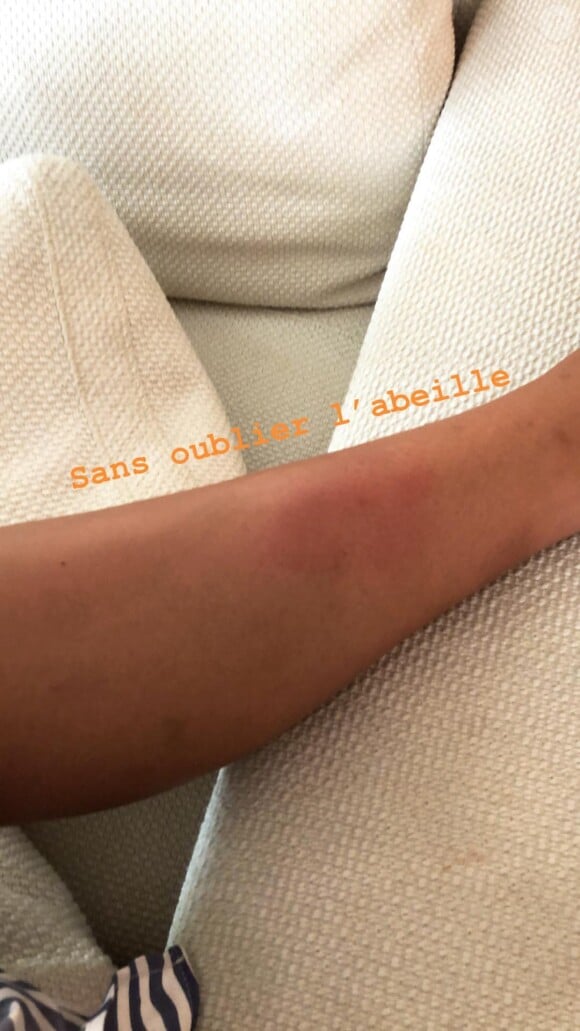 Camille Cerf a été attaquée par des moustiques et des abeilles lors de ses vacances. Août 2018.