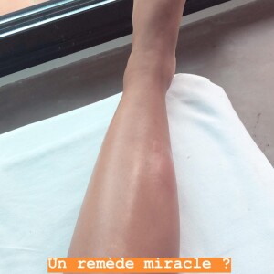 Camille Cerf a été attaquée par des moustiques et des abeilles lors de ses vacances. Août 2018.