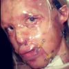 Katie Piper a posté une photo de son visage après son agression à l'acide