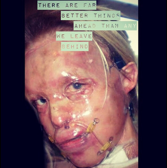 Katie Piper a posté une photo de son visage après son agression à l'acide