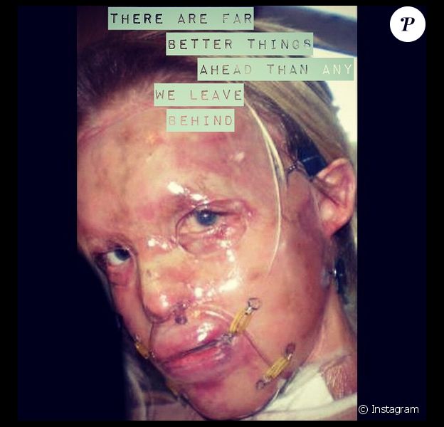 Katie Piper a post&eacute; une photo de son visage apr&egrave;s son agression &agrave; l'acide