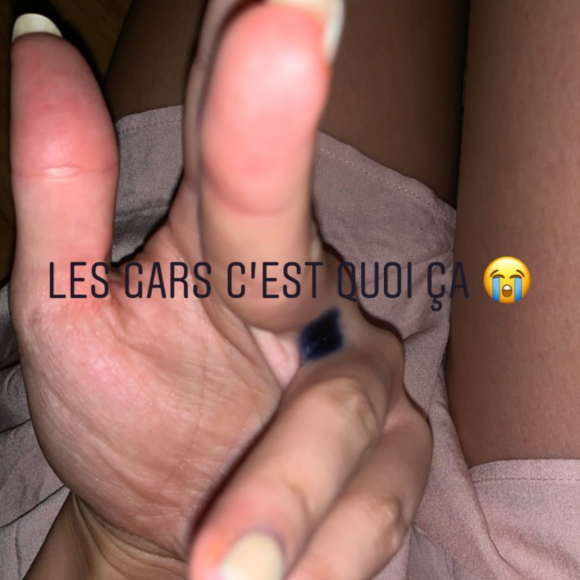 Agathe Auproux, guérie de son cancer, s'inquiète pour une tâche bleue qui est apparue entre ses doigts, comme elle le révèle le 1er juillet 2019 en story sur Instagram.