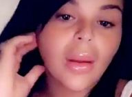 Sarah Fraisou : Défigurée par la chirurgie esthétique, elle raconte son calvaire