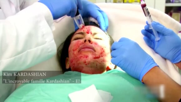 Kim Kardashian subit un "Vampire Facial" dans l'émission L'Incroyable famille Kardashian. 2013.