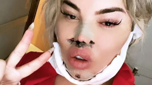 Jessica Alves : Nouvelle opération au visage après une grave infection