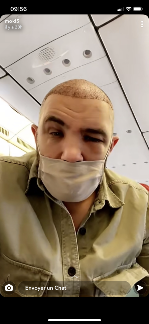 Mohamed (Koh-Lanta 2005) dévoile son visage tout gonflé après sa greffe de cheveux à Istanbul - Snapchat