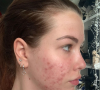 EnjoyPhoenix (de son vrai nom Marie Lopez), a révélé l'évolution de son traitement contre l'acné. Elle écrit : "Je reviens de loin."