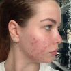 EnjoyPhoenix : Sa peau ravagée par l'acné, elle montre l'évolution de son traitement