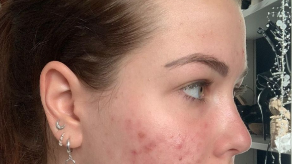 EnjoyPhoenix : Sa peau ravagée par l'acné, elle montre l'évolution de son traitement