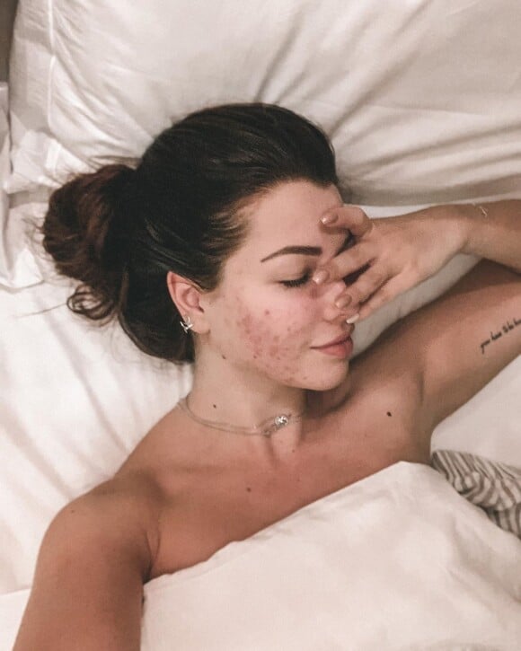 Marie Lopez (EnjoyPhoenix) dévoile et assume son acné, le dimanche 1er mars 2020 sur Instagram.