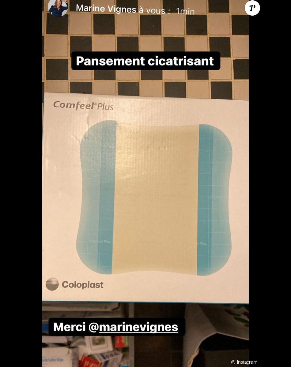 Laurie Cholewa s'est brûlée, elle partage une photo et donne des conseils