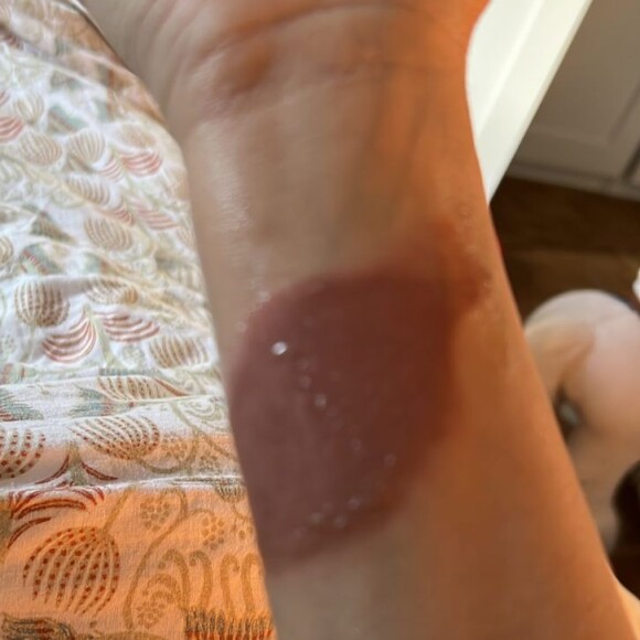 Laurie Cholewa s'est brûlée, elle partage une photo et donne des conseils