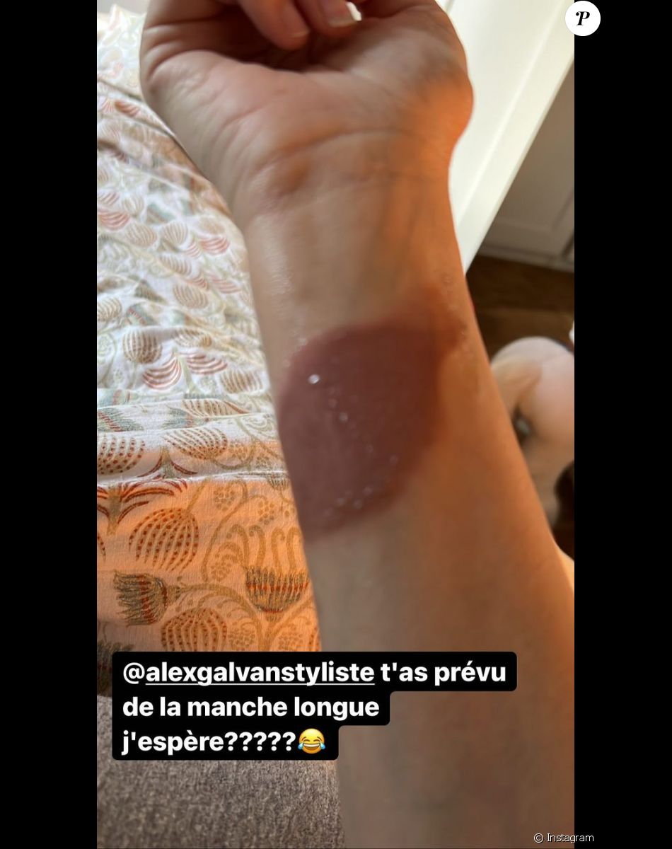 Laurie Cholewa s'est brûlée, elle partage une photo et donne des conseils