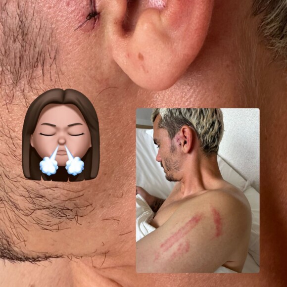 Une blessure qui a fait réagir Erika, qui a mis un emoji d'elle en train de soupirer longuement