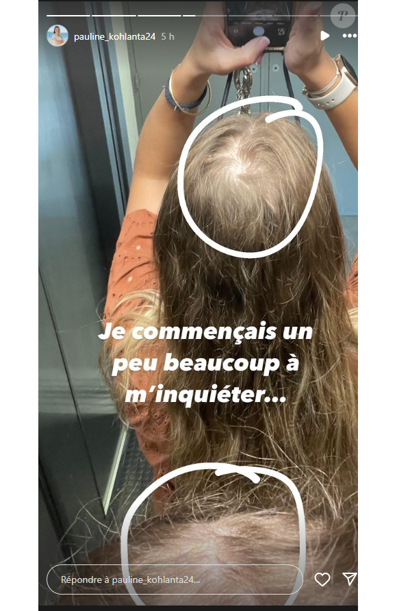 Elle avait même un trou sur la tête
Pauline de "Koh-Lanta" dévoile qu'elle a perdu beaucoup de cheveux