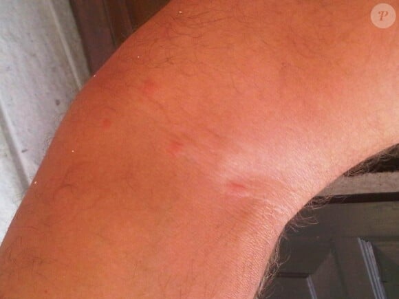 Nikos Aliagas victime d'un moustique : la preuve