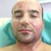 Yoni Roch, dans son lit d'hôpital, brûlé au deuxième degré, le jeudi 27 septembre 2012.