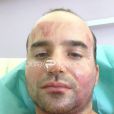 Yoni Roch, dans son lit d'hôpital, brûlé au deuxième degré, le jeudi 27 septembre 2012.