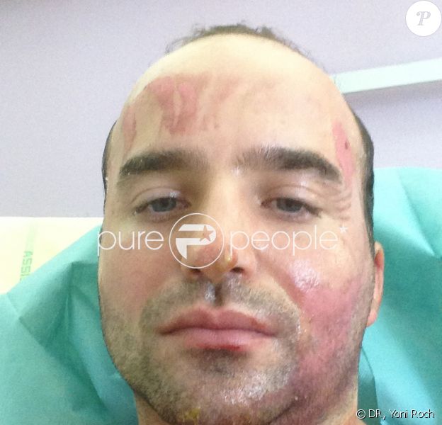 Yoni Roch, dans son lit d'hôpital, brûlé au deuxième degré, le jeudi 27 septembre 2012.