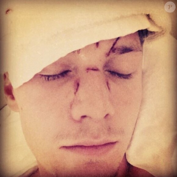 Barron Hilton a publié une photo de son visage après avoir été agressé le 6 décembre 2013 à Miami.