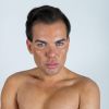 Le Brésilien Rodrigo Alves âgé de seulement 31 ans a déjà subi plus d'une trentaine d'opérations de chirurgie esthétique. De nombreux actes médicaux qui ont failli lui coûter la vie puisqu'il est déjà resté paralysé et incapable de se nourrir ou de se laver. Toutefois il jure pour l'instant de ne jamais s'arrêter.