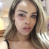 Katie Piper les yeux rouges avant de se rendre aux urgences, le 13 mars 2017