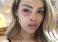 Katie Piper : Le mannequin défiguré à l'acide hospitalisé en urgence !