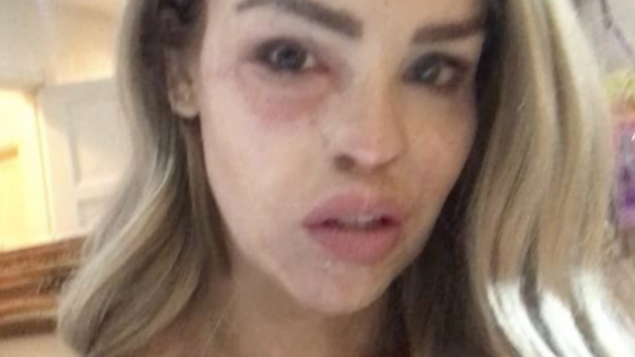 Katie Piper : Le mannequin défiguré à l'acide hospitalisé en urgence !