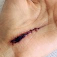 Alexandra Rosenfeld dévoile la cicatrice de sa main après son accident - Instagram, 20 juillet 2020