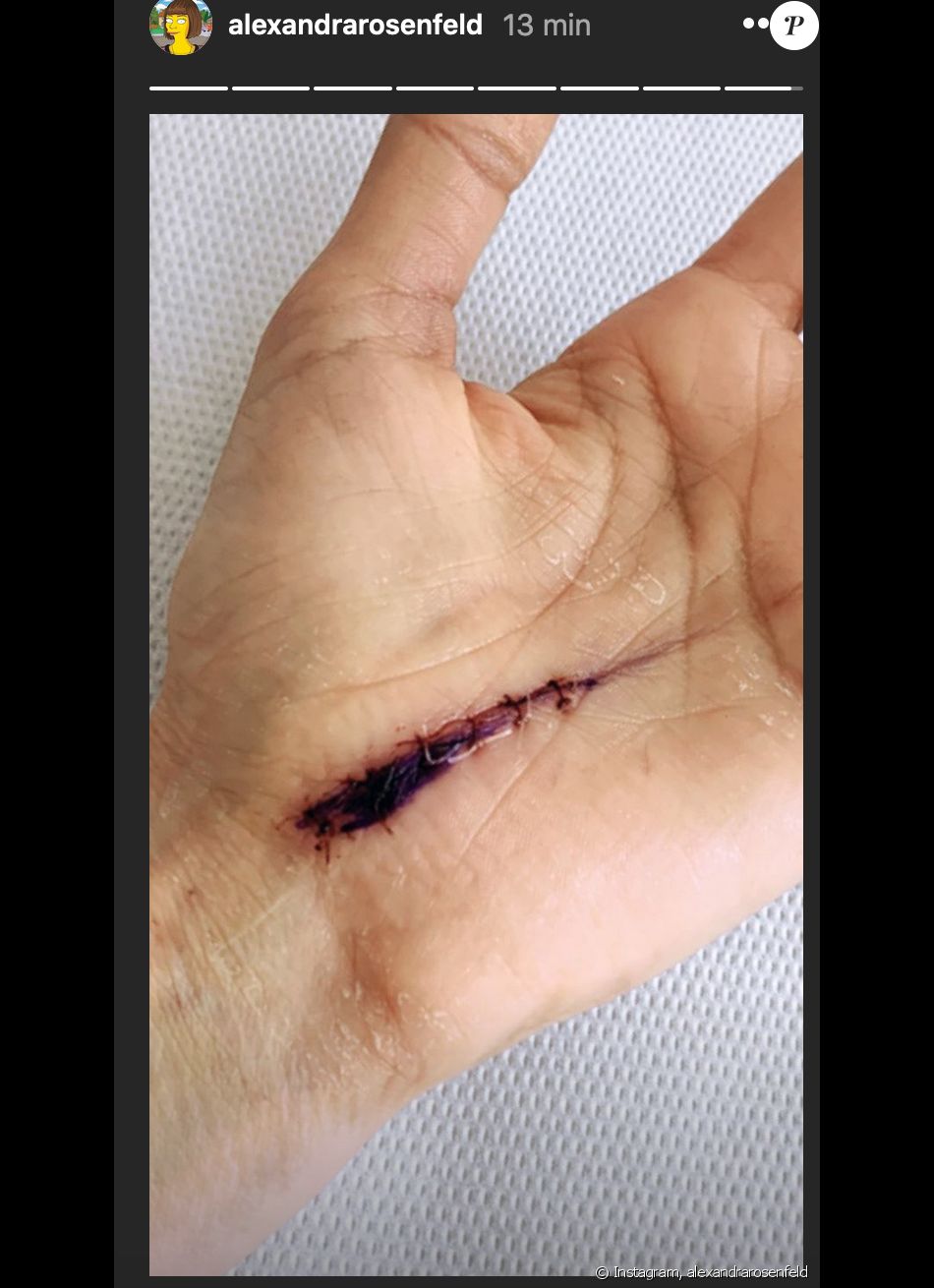 Alexandra Rosenfeld dévoile la cicatrice de sa main après son accident - Instagram, 20 juillet 2020
