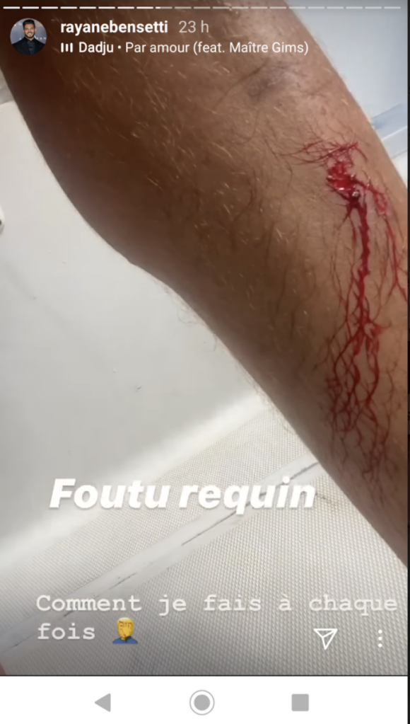 Rayane Bensetti dévoile sa blessure sur Instagram - 31 juillet 2020