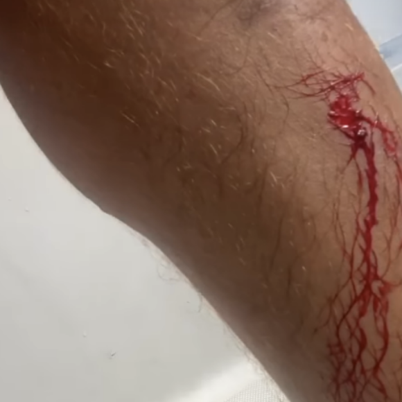 Rayane Bensetti dévoile sa blessure sur Instagram - 31 juillet 2020