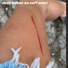 Laury Thilleman se blesse en surf pendant ses vacances  dans le Sud-Ouest de la France - Instagram, 17 août 2020