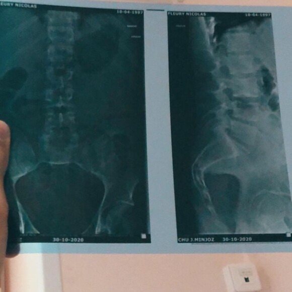 Nicolas Fleury, le compagnon de Vaimalama Chaves, à l'hôpital