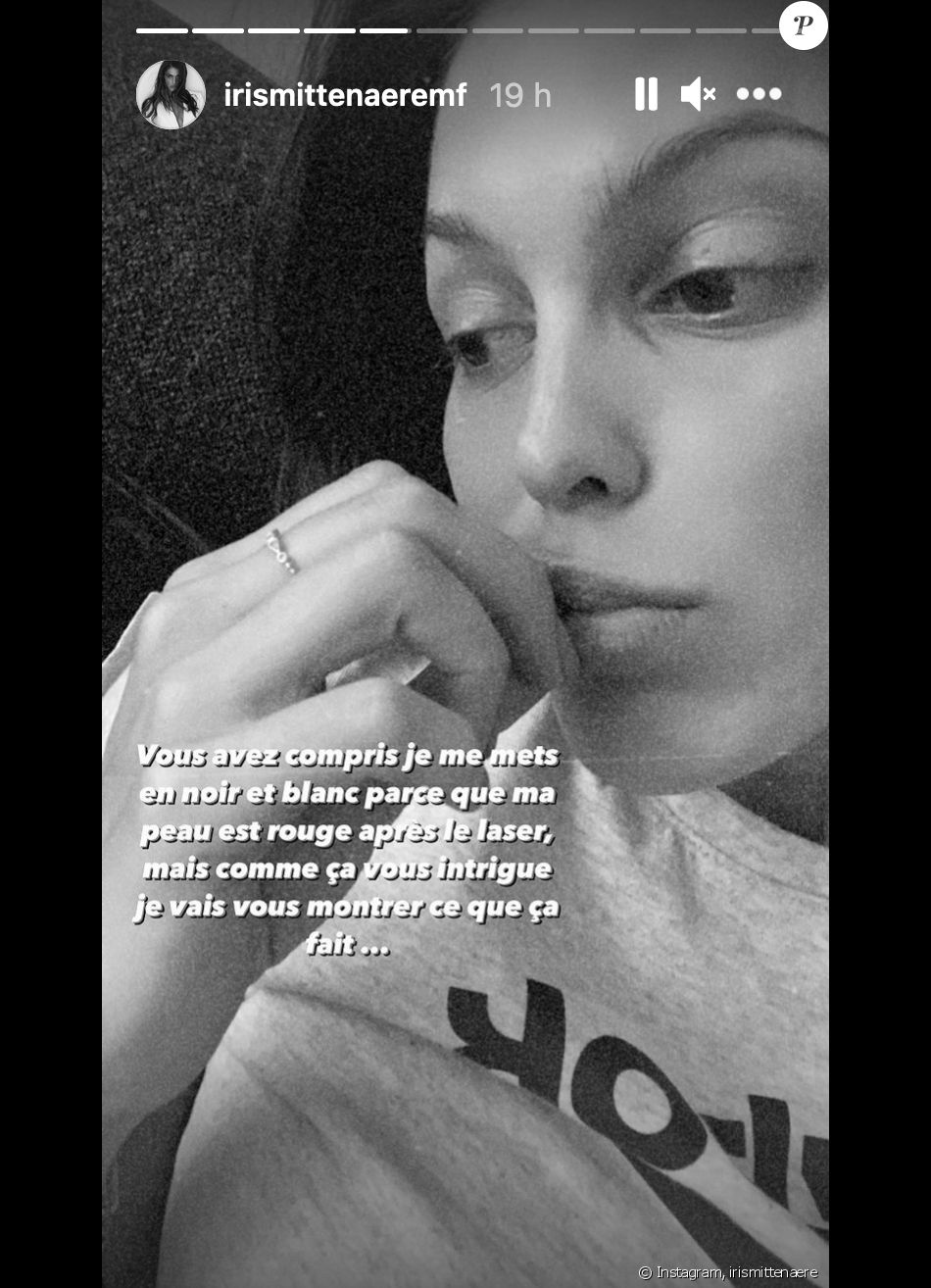 Iris Mittenaere, des plaques rouges sur son visage l'effet