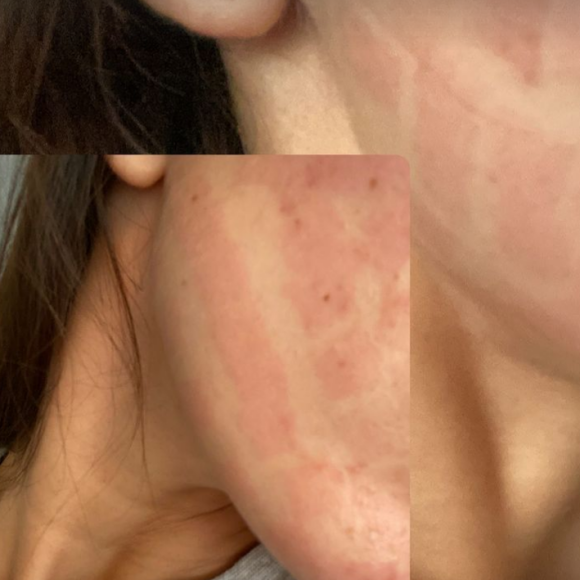 Iris Mittenaere dévoile son visage marqué de plaques rouges après une intervention au laser - Instagram