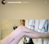 Jean-Edouard Lipa dévoile une nouvelle photo de sa gigantesque cicatrice après son opération de la jambe - Instagram