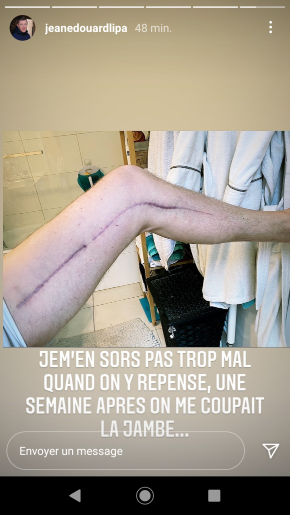 Jean-Edouard Lipa dévoile une nouvelle photo de sa gigantesque cicatrice après son opération de la jambe - Instagram